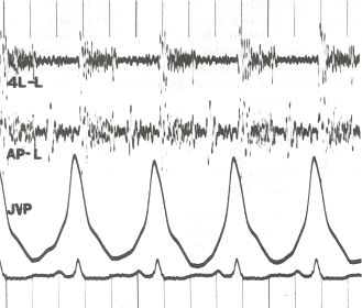 File:Phonocardiogram.jpg