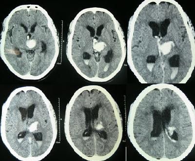 File:Intracerebral hemorrhage.jpg