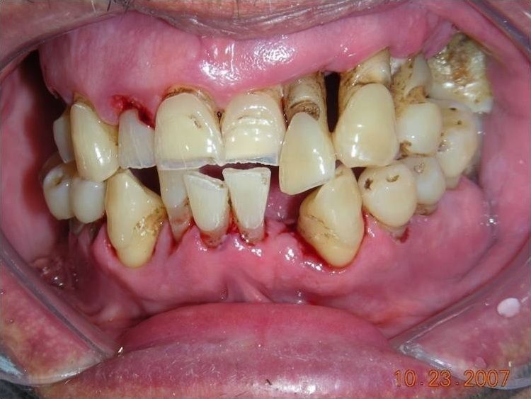 File:Periodontitis Crónica Severa.JPG