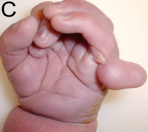 File:HandTrisomy13.png