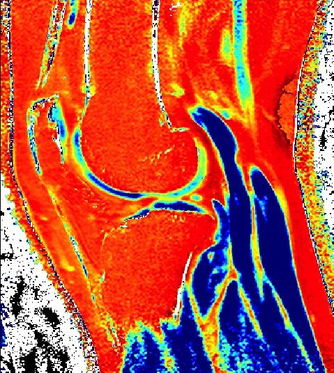 File:T1 Map of cartilage.jpg