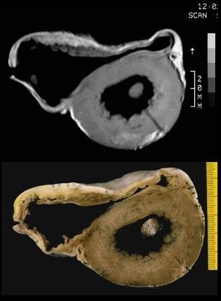 File:Arrhythmogenic right ventricular cardiomyopathy.jpg