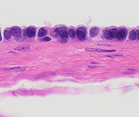 File:Histopathology of paratubal cyst.jpg