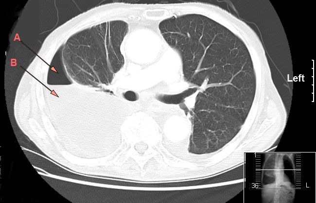 File:Hydro pneumothorax.jpg