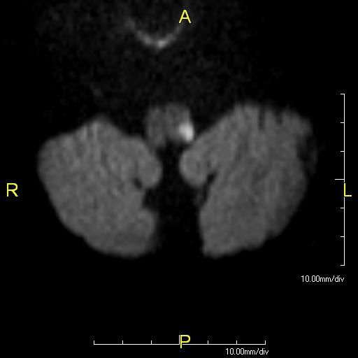 File:WallenbergInfarct001.jpg