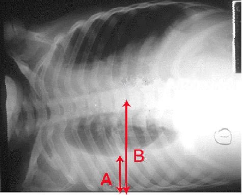 File:Pleural effusion.jpg