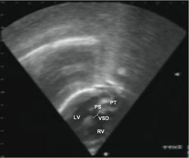 File:Transposition great arteries Orphanet 1750-1172-3-27-4.JPEG