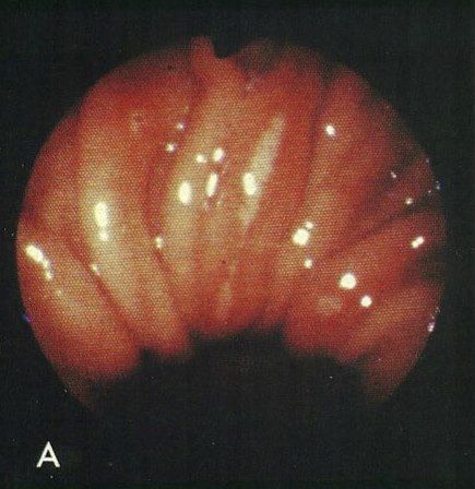 File:Cameron lesions wiki (photos only)Image.jpg