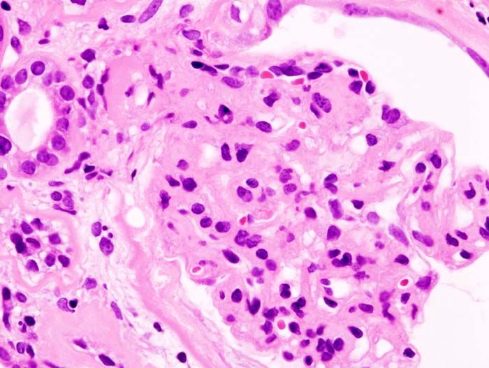 File:Diabetic glomerulosclerosis (1) HE.jpg