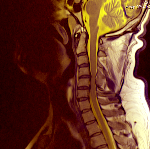 File:Neck MRI 133023.png