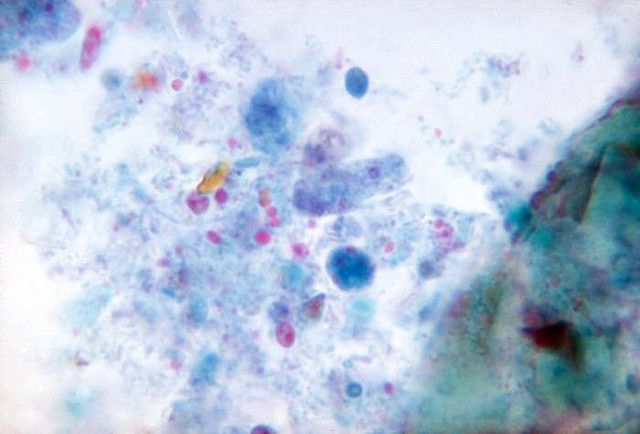 File:Dientamoeba fragilis (3027773918).jpg