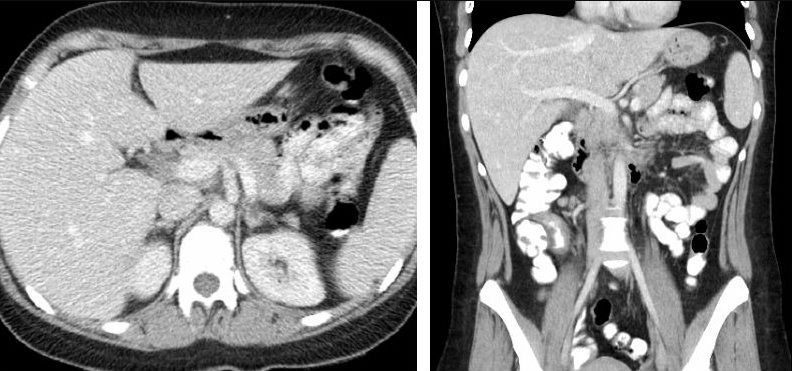 File:Normal contrast enhanced abdominal CT.jpg