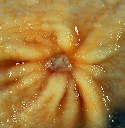 File:Benign gastric ulcer 1.jpg