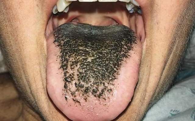 File:Black hairy tounge.jpg