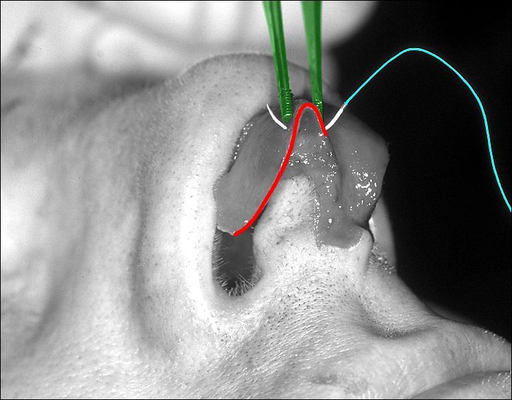 File:RhinoplastyNarrowTip.jpg