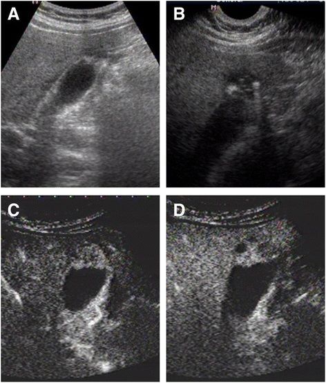 File:Ultrasound of gallbladder adenomyosis.jpg