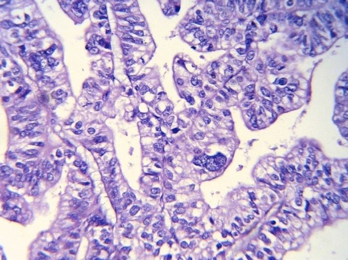 File:Histopathology of gallbladder carcinoma.jpg