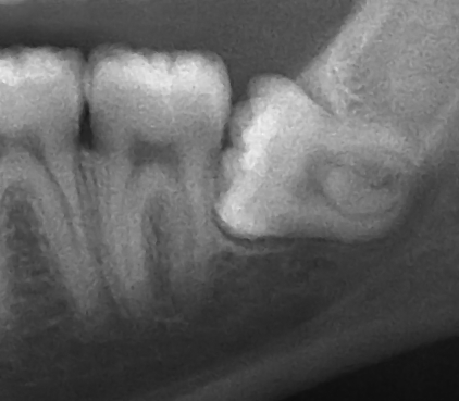 File:Horizontal impacted wisdom tooth.png