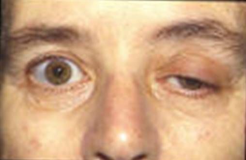 File:Myasthenia.jpg