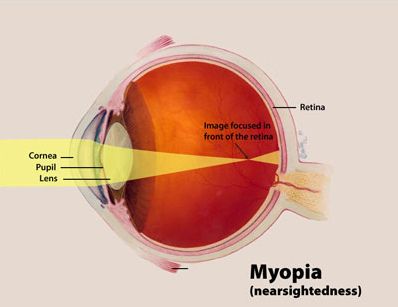 File:Myopia Diagram.jpg