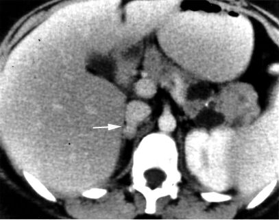 File:Pheochromocytoma2.jpg