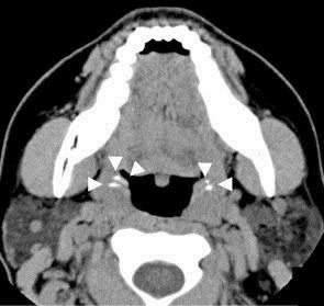 File:CT of tonsilloliths.jpg