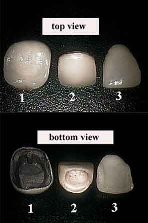 File:Comparison - Crowns and veneer.jpg