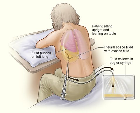 File:Thoracentesis.jpg