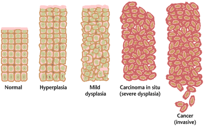 File:Cancer progression from NIH.png