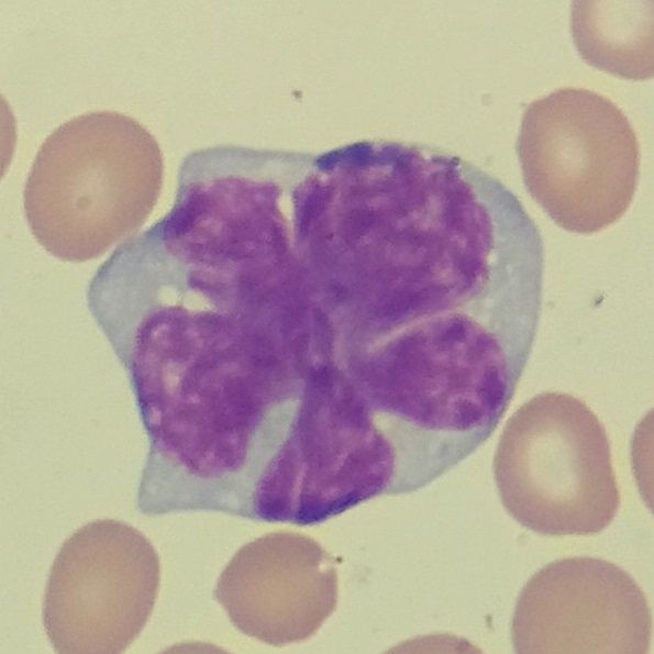 File:Flower cell in mantle cell lymphoma cropped.jpg