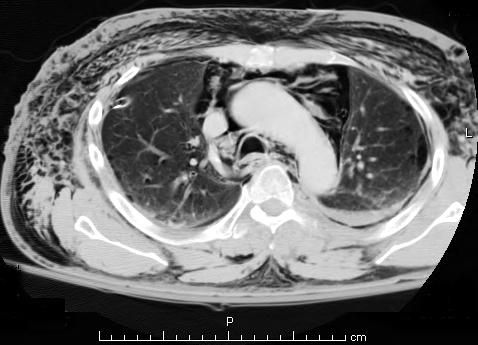 File:Subcutaneous emphysema chest cropped.jpg