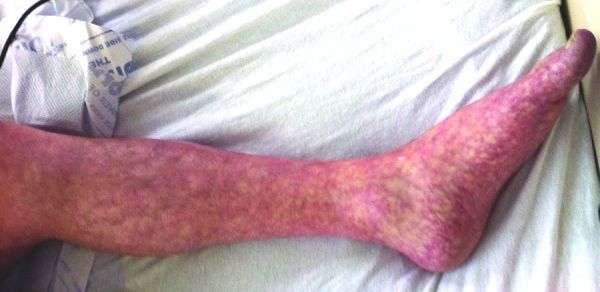 File:Livedo reticularis of left leg.jpg