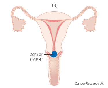 File:Diagram-showing-stage-1B1-cervical-cancer.png