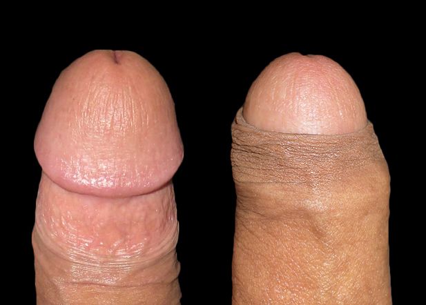 File:Intact Penis - foreskin retracted.jpg