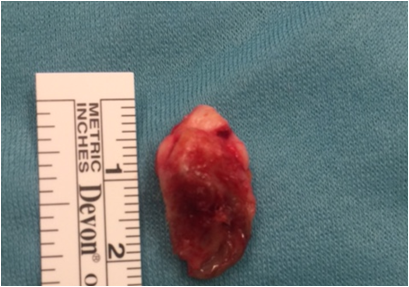 File:Pilonidal Cyst.png