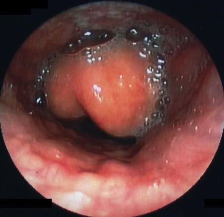 File:Epiglottitis endoscopy.jpg