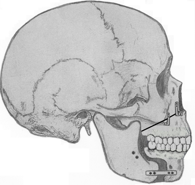 File:Maxillomadibular advancement.png