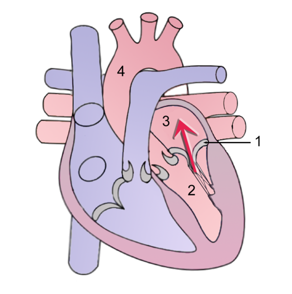 File:Mitral Regurgitation scheme1.png