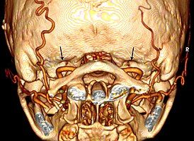 Bilateral condylar canals (arrows) above the vertebral arteries.