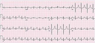 ECG of a 47-year-old male with hypocalcemia and calcium level = 5.3 mg/dL