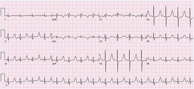 File:ECG Hypocalcemia.jpg