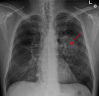 Infobox medical condition (old)/simple/sandboxA chest X-ray showing a tumor in the lung (marked by arrow)