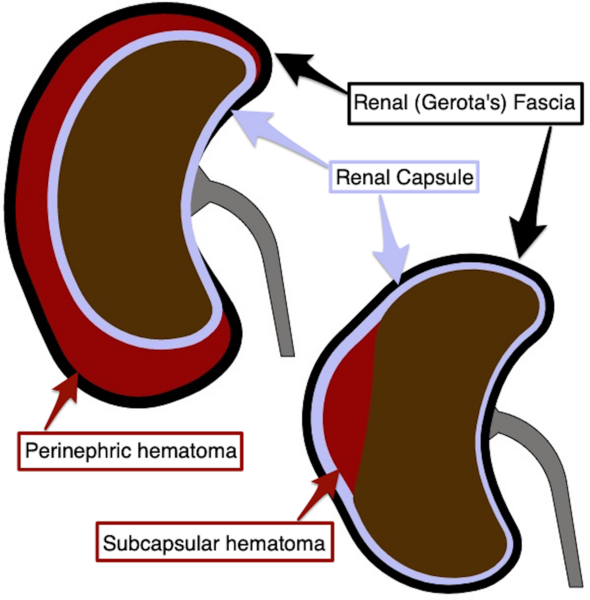 File:Renal hematoma diagram.png