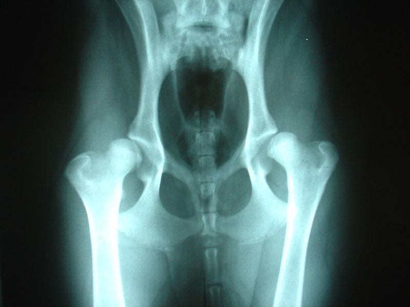 File:Bilateral hip dysplasia.JPG