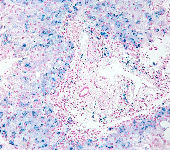 File:Hemosiderosis high mag.jpg