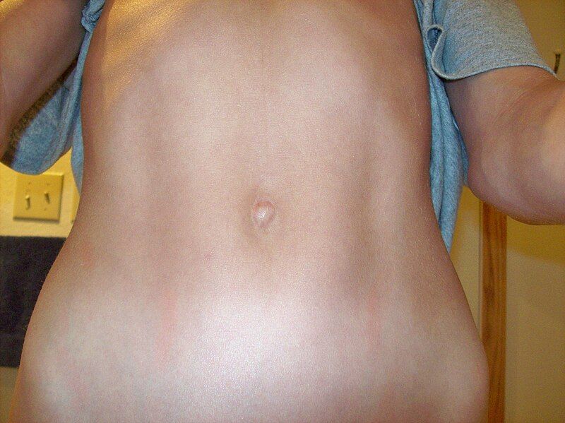 File:Outie navel 2.jpg