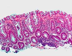 Microvesicular hyperplastic polyp. H&E stain.