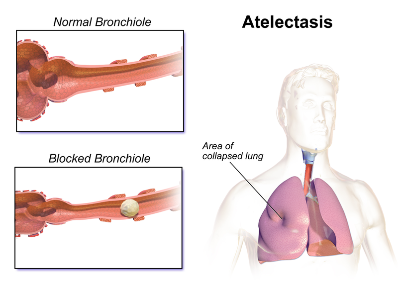 File:Atelectasis.png