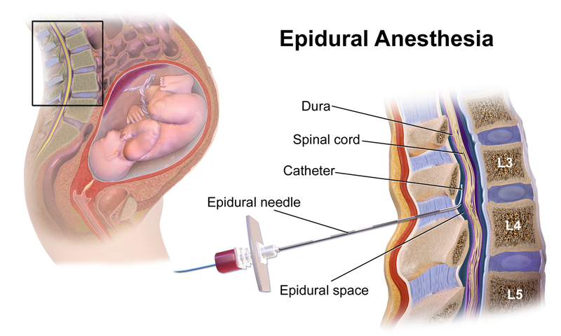 File:Epidural Anesthesia.png