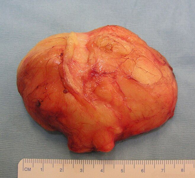 File:Lipoma 06.jpg